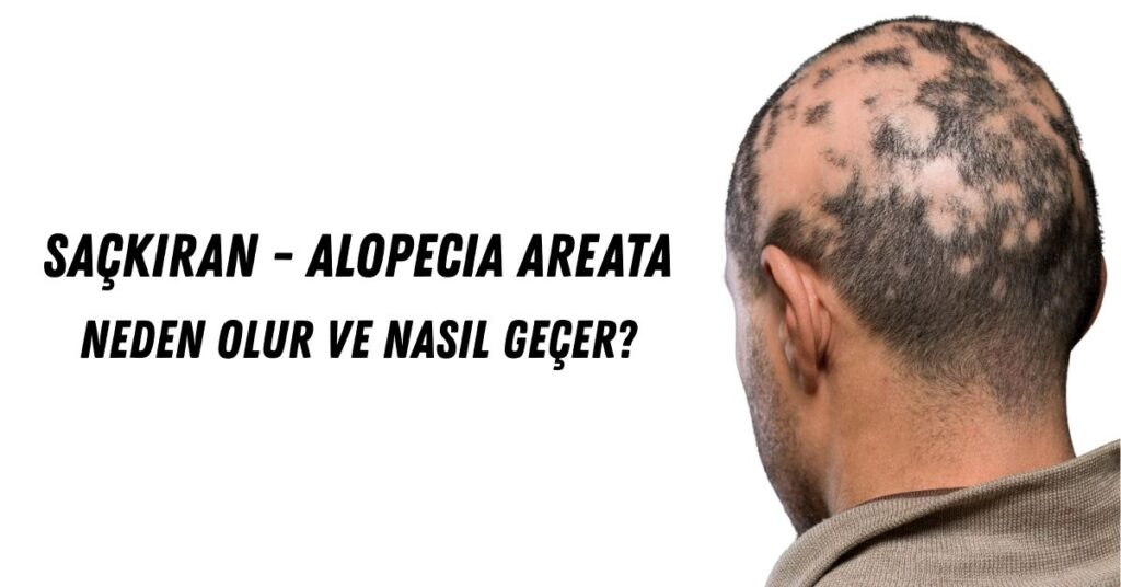 Saçkıran tıp dilindeki tabiri ile alopecia areata olup bölgesel saç, sakal ve kaşların dökülmesidir.