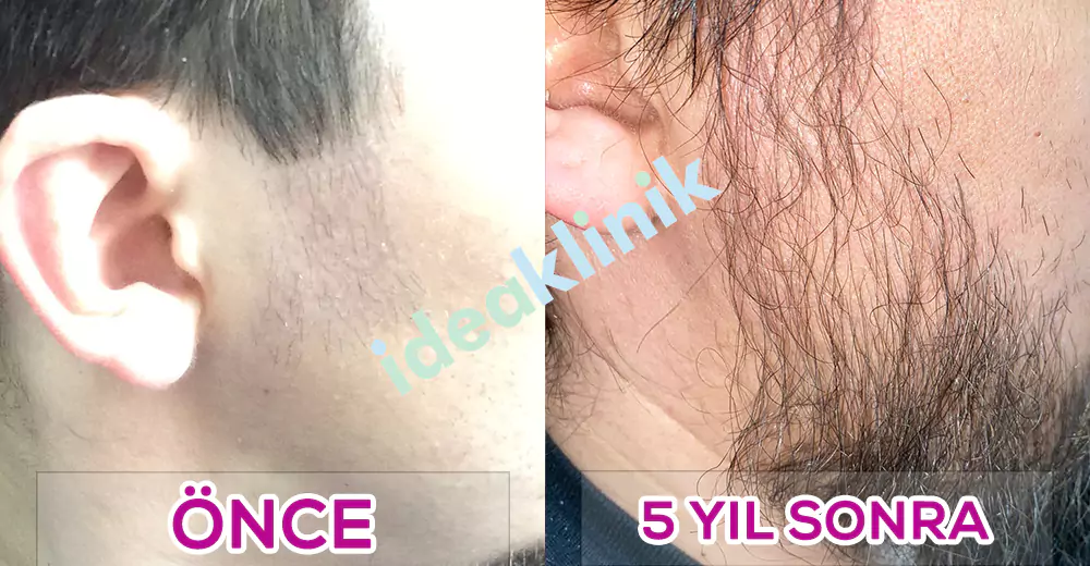 sakal ekimi öncesi ve sonrası