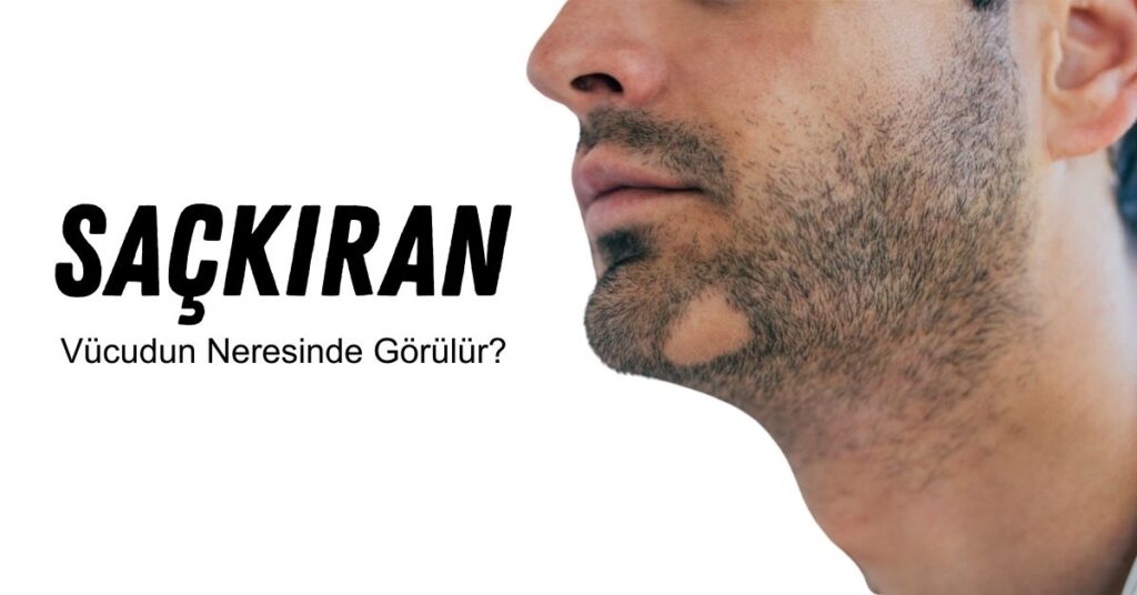 Sakal kıran olarak bilinen sakallarda bölgesel dökülme saçkıran kaynaklı olup geçicidir.